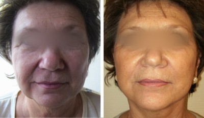 Before and after face lift