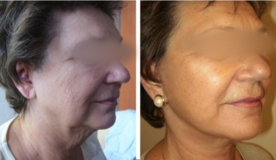 Before and after face lift