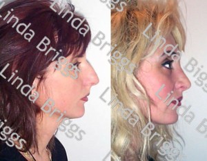 Before and after rhinoplasty surgery