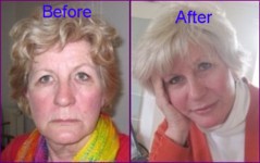 Diary of a face lift in Budapest, Hungary - before and after
