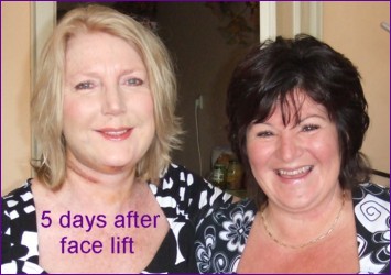 5 days after face lift in Budapest Hungary
