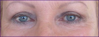 Linda Briggs after sugery