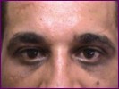 Blepharoplasty after surgery