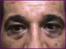 Blepharoplasty before surgery
