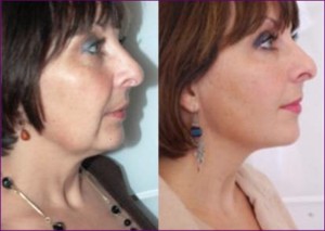 Before and After French lift with Dr Bellity