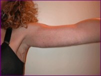 before arm lift surgery